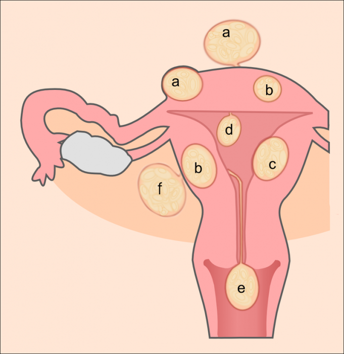 Schematic drawing of various types of uterine fibroids